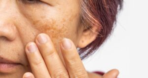 Pele Ressecada na Menopausa